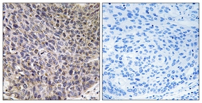 IHC of paraffin-embedded human lung carcinoma tissue, using Cytochrome P450 4B1 Antibody. The picture on the right is treated with the synthesized peptide.