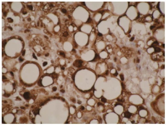 A. IHC of human liposarcoma cells using CYP4F11 antibody (LS-C27027). B. Western blot of CYP4F11 antibody one normal (2) and cancerous (3) kidney cell lysates.