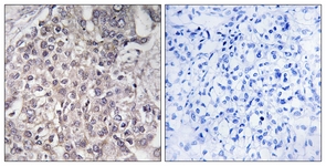 IHC of paraffin-embedded human liver carcinoma, using Cytochrome P450 4F2 Antibody. The picture on the right is treated with the synthesized peptide.