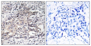 IHC of paraffin-embedded human liver carcinoma tissue, using Cytochrome P450 4X1 Antibody. The picture on the right is treated with the synthesized peptide.