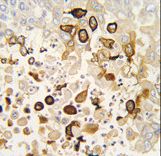 Formalin-fixed and paraffin-embedded human lung carcinoma tissue reacted with CYP4X1 antibody , which was peroxidase-conjugated to the secondary antibody, followed by DAB staining. This data demonstrates the use of this antibody for immunohistochemistry; clinical relevance has not been evaluated.