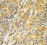 Formalin-fixed and paraffin-embedded human prostate carcinoma reacted with CYP51A1 Antibody , which was peroxidase-conjugated to the secondary antibody, followed by DAB staining. This data demonstrates the use of this antibody for immunohistochemistry; clinical relevance has not been evaluated.
