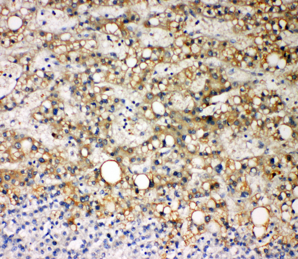 CYP7A1 antibody. IHC(P): Human Liver Cancer Tissue.