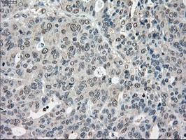 IHC of paraffin-embedded Adenocarcinoma of endometrium tissue using anti-POR mouse monoclonal antibody. (Dilution 1:50).