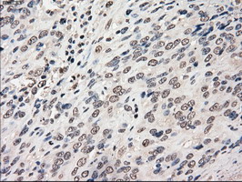 IHC of paraffin-embedded Carcinoma of bladder tissue using anti-POR mouse monoclonal antibody. (Dilution 1:50).