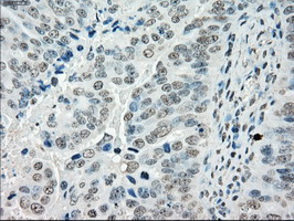 IHC of paraffin-embedded Adenocarcinoma of ovary tissue using anti-POR mouse monoclonal antibody. (Dilution 1:50).