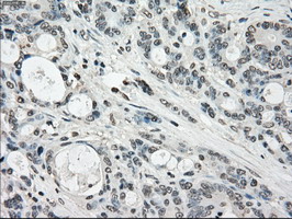 IHC of paraffin-embedded Adenocarcinoma of colon tissue using anti-POR mouse monoclonal antibody. (Dilution 1:50).