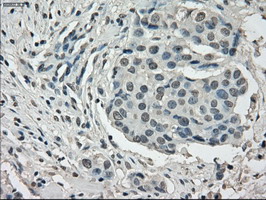 IHC of paraffin-embedded Adenocarcinoma of breast tissue using anti-POR mouse monoclonal antibody. (Dilution 1:50).