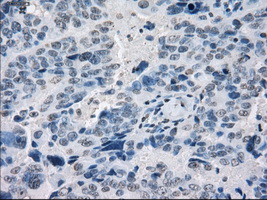 IHC of paraffin-embedded Adenocarcinoma of ovary tissue using anti-POR mouse monoclonal antibody. (Dilution 1:50).