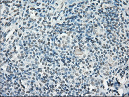 IHC of paraffin-embedded Carcinoma of thyroid tissue using anti-POR mouse monoclonal antibody. (Dilution 1:50).