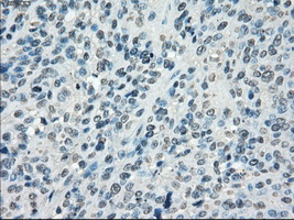 IHC of paraffin-embedded Carcinoma of bladder tissue using anti-POR mouse monoclonal antibody. (Dilution 1:50).