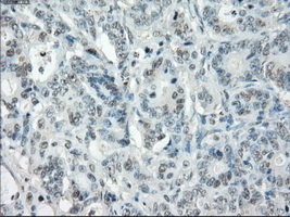 IHC of paraffin-embedded Adenocarcinoma of colon tissue using anti-POR mouse monoclonal antibody. (Dilution 1:50).