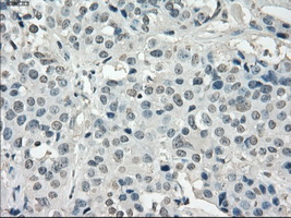 IHC of paraffin-embedded Adenocarcinoma of breast tissue using anti-POR mouse monoclonal antibody. (Dilution 1:50).