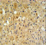 P450R Antibody IHC of formalin-fixed and paraffin-embedded human hepatocarcinoma tissue followed by peroxidase-conjugated secondary antibody and DAB staining.