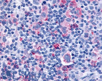 Anti-CYSLTR1 / CYSLT1 antibody IHC of human Lymph Node, Hodgkins Lymphoma. Immunohistochemistry of formalin-fixed, paraffin-embedded tissue after heat-induced antigen retrieval.