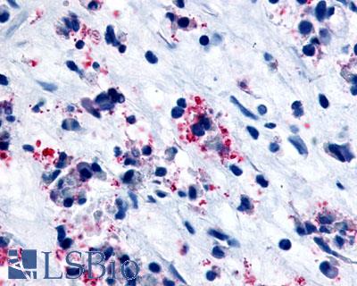 Anti-CYSLTR1 / CYSLT1 antibody LS-A1320 IHC of human nasal mucosa, allergic rhinitis, eosinophils. Immunohistochemistry of formalin-fixed, paraffin-embedded tissue after heat-induced antigen retrieval.