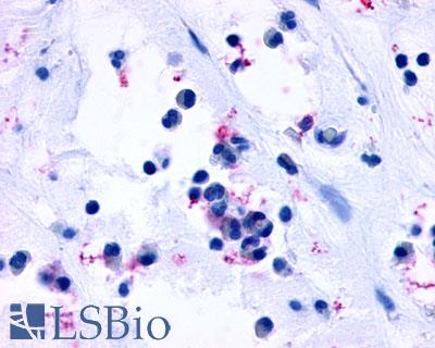 Anti-CYSLTR1 / CYSLT1 antibody LS-A1317 IHC of human nasal mucosa, allergic rhinitis, eosinophils. Immunohistochemistry of formalin-fixed, paraffin-embedded tissue after heat-induced antigen retrieval.