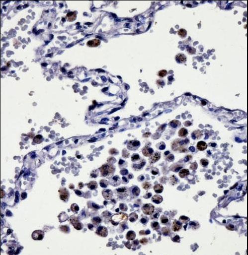 CYSLTR1 Antibody immunohistochemistry of formalin-fixed and paraffin-embedded human lung tissue followed by peroxidase-conjugated secondary antibody and DAB staining.