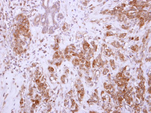 IHC of paraffin-embedded Breast carcinoma, using CHAD antibody at 1:250 dilution.