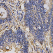Immunohistochemistry of paraffin-embedded human rectal cancer using CLCN5 antibody at dilution of 1:200 (x400 lens)