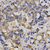 Immunohistochemistry of paraffin-embedded human lung cancer using CLCN5 antibody at dilution of 1:200 (x400 lens).