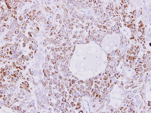 IHC of paraffin-embedded A549 xenograft using Creatine kinase 1B antibody at 1:300 dilution.