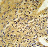 COQ5 Antibody IHC of formalin-fixed and paraffin-embedded human lung carcinoma followed by peroxidase-conjugated secondary antibody and DAB staining.