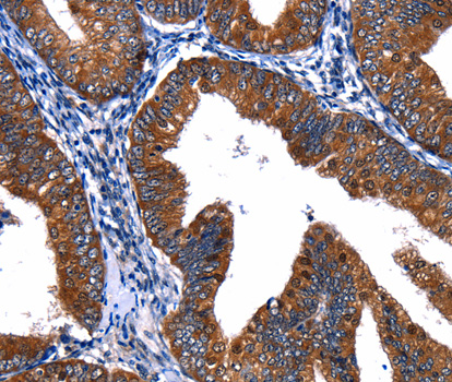 Immunohistochemistry of paraffin-embedded human cervical cancer tissue using CUL4A antibody.