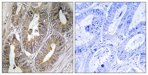 IHC of paraffin-embedded human colon carcinoma, using CST2 Antibody. The picture on the right is treated with the synthesized peptide.
