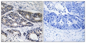 IHC of paraffin-embedded human colon carcinoma, using Cytochrome P450 2R1 Antibody. The picture on the right is treated with the synthesized peptide.