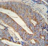 DACT1 antibody immunohistochemistry of formalin-fixed and paraffin-embedded human prostate carcinoma followed by peroxidase-conjugated secondary antibody and DAB staining.