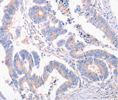 Immunohistochemistry of paraffin-embedded human colon cancer tissue using EIF4G2 antibody.
