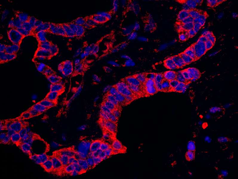 Detection of Human DAP5 by Immunohistochemistry. Sample: FFPE section of human ovarian carcinoma. Antibody: Affinity purified rabbit anti-DAP5 used at a dilution of 1:100. Detection:Red-fluorescent Goat anti-Rabbit IgG-heavy and light chain cross-adsorbed Antibody DyLight 594 Conjugated (A120-601D4) used at a dilution of 1:100.