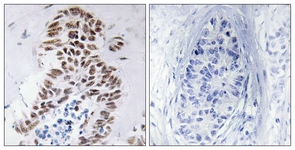 IHC of paraffin-embedded human lung carcinoma tissue, using DAPK3 (Ab-265) Antibody. The picture on the right is treated with the synthesized peptide.