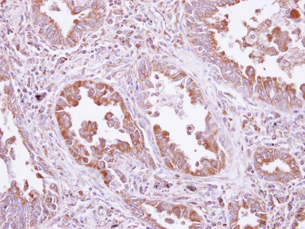 IHC of paraffin-embedded Lung ca, using DARS antibody at 1:500 dilution.