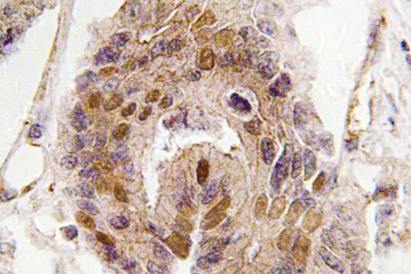 IHC of DATF1 / DIDO1 (S186) pAb in paraffin-embedded human colon carcinoma tissue.