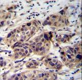WDR42C Antibody immunohistochemistry of formalin-fixed and paraffin-embedded human breast carcinoma followed by peroxidase-conjugated secondary antibody and DAB staining.