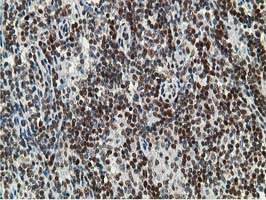 IHC of paraffin-embedded Human lymphoma tissue using anti-DCK mouse monoclonal antibody.