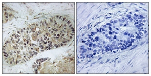 IHC of paraffin-embedded human lung carcinoma, using Artemis (Phospho-Ser516) Antibody. The sample on the right was incubated with synthetic peptide.
