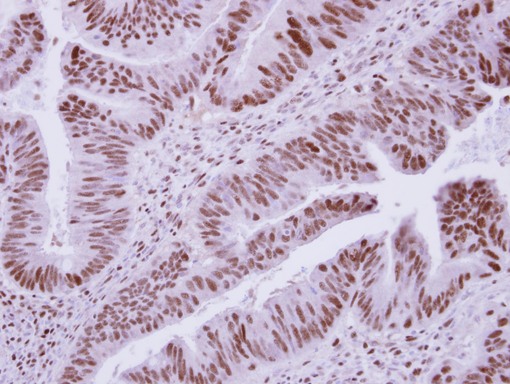 IHC of paraffin-embedded Colon ca, using DCPS antibody at 1:250 dilution.