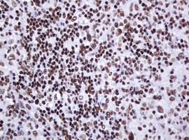 IHC of paraffin-embedded Human lymphoma tissue using anti-DCPS mouse monoclonal antibody.