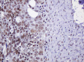 IHC of paraffin-embedded Adenocarcinoma of Human ovary tissue using anti-DCPS mouse monoclonal antibody.