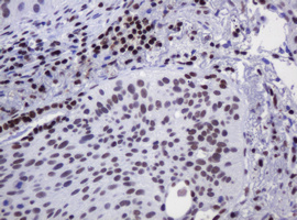 IHC of paraffin-embedded Carcinoma of Human lung tissue using anti-DCPS mouse monoclonal antibody.