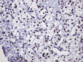 IHC of paraffin-embedded Carcinoma of Human kidney tissue using anti-DCPS mouse monoclonal antibody.