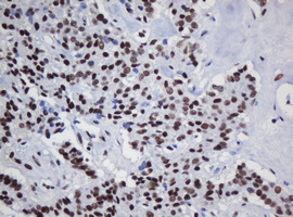 IHC of paraffin-embedded Carcinoma of Human pancreas tissue using anti-DCPS mouse monoclonal antibody.