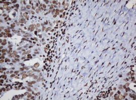 IHC of paraffin-embedded Adenocarcinoma of Human ovary tissue using anti-DCPS mouse monoclonal antibody.