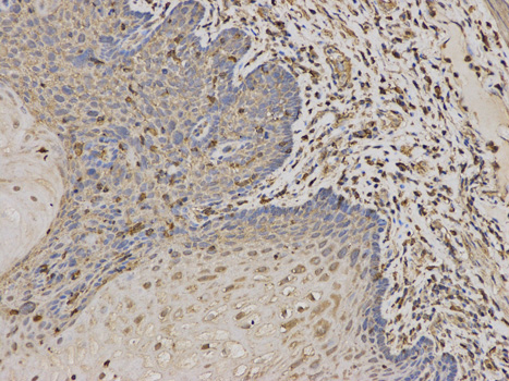 Immunohistochemistry of paraffin-embedded human esophageal cancer using DCTN1 antibody at dilution of 1:100 (200x lens).