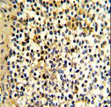 Formalin-fixed and paraffin-embedded human kidney carcinoma with DCXR Antibody , which was peroxidase-conjugated to the secondary antibody, followed by DAB staining. This data demonstrates the use of this antibody for immunohistochemistry; clinical relevance has not been evaluated.