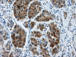IHC of paraffin-embedded Carcinoma of liver tissue using anti-DCXR mouse monoclonal antibody. (Dilution 1:50).