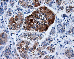 IHC of paraffin-embedded Carcinoma of liver tissue using anti-DCXR mouse monoclonal antibody. (Dilution 1:50).